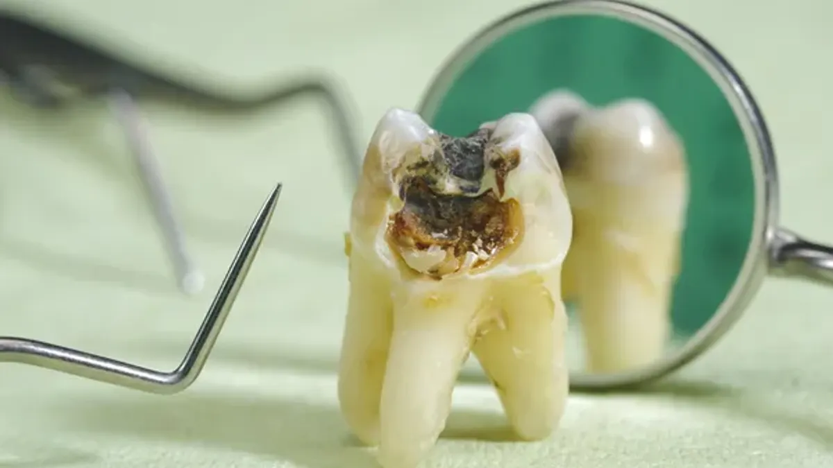 A prevenção de cáries é fundamental para manter a saúde bucal e garantir uma boa qualidade de vida
