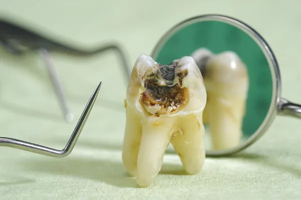 A prevenção de cáries é fundamental para manter a saúde bucal e garantir uma boa qualidade de vida.